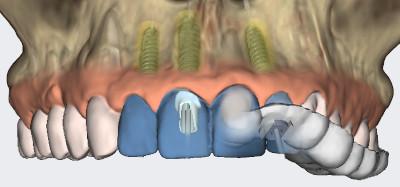 Dental Implant CT Scan