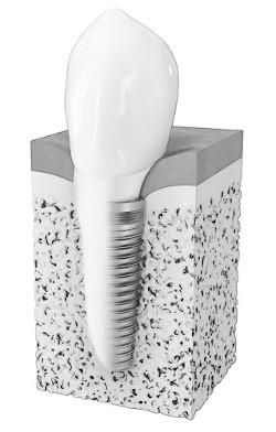Dental Implant model